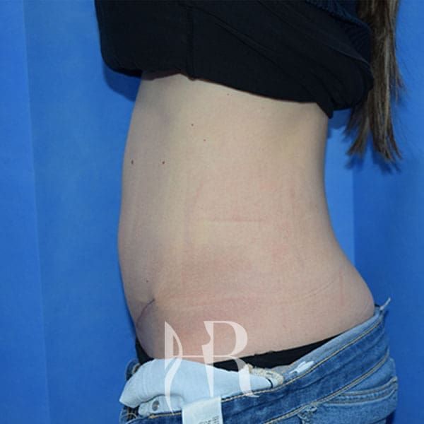 HR Plastic Surgery - Diastasis Recti Surgery patient after 2
