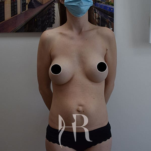 HR Plastic Surgery - Diastasis Recti Surgery patient before 1