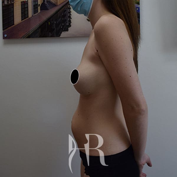 HR Plastic Surgery - Diastasis Recti Surgery patient before 2