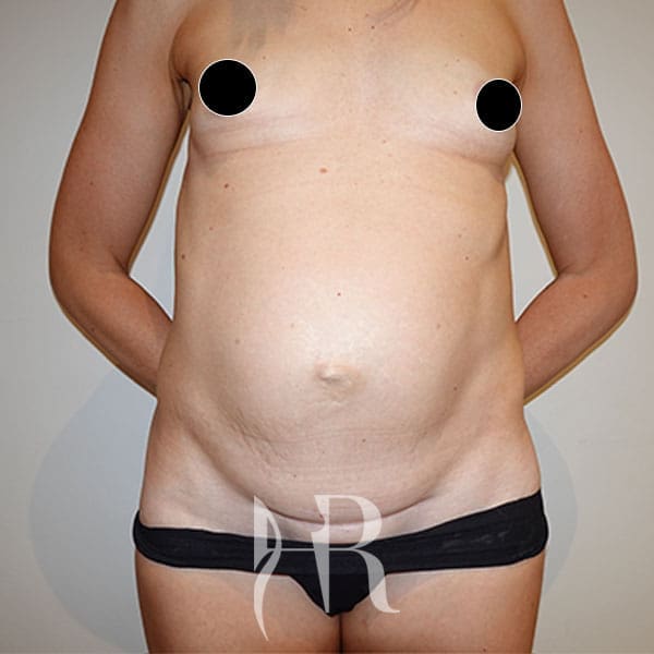 HR Plastic Surgery - Diastasis Recti Surgery patient before 3