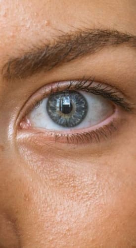 HR Plastic Surgery - Eyelid Surgery (Blepharoplasty) Causes