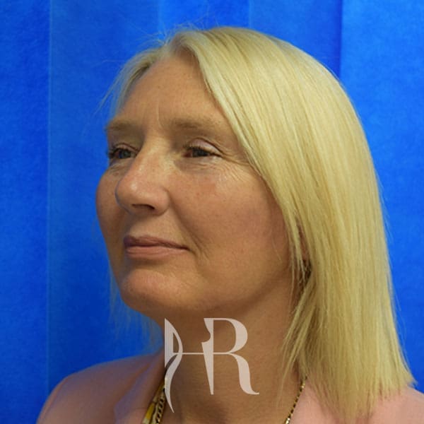 HR Plastic Surgery - Facelift patient after 1