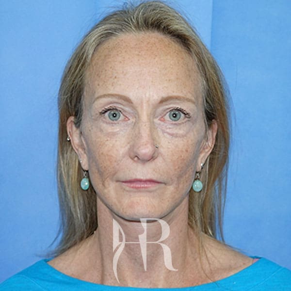 HR Plastic Surgery - Facelift patient after 2