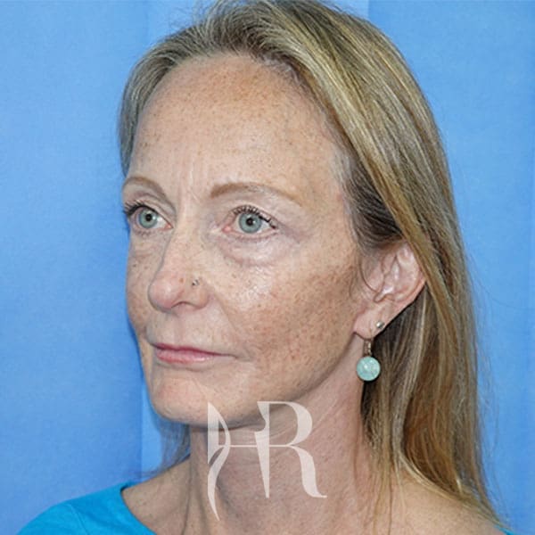 HR Plastic Surgery - Facelift patient after 3