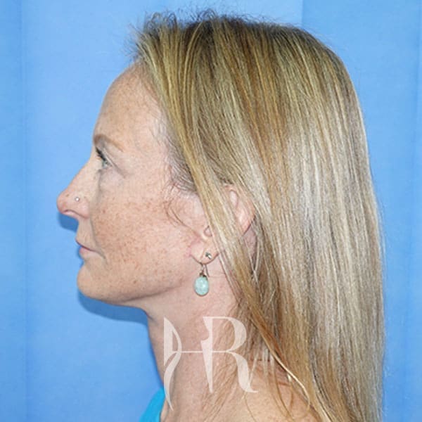 HR Plastic Surgery - Facelift patient after 4