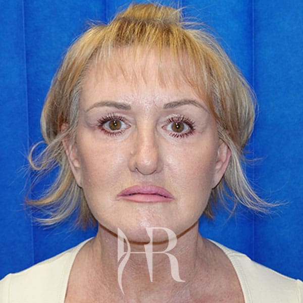 HR Plastic Surgery - Facelift patient after 5