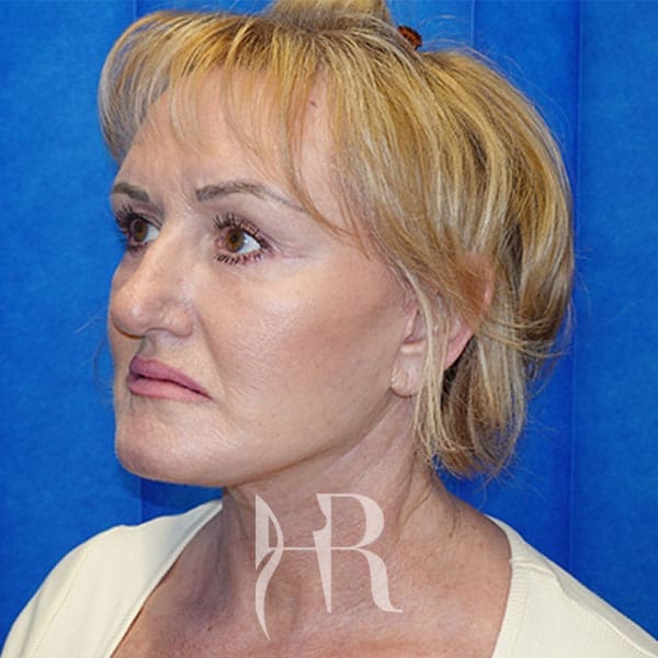HR Plastic Surgery - Facelift patient after 6