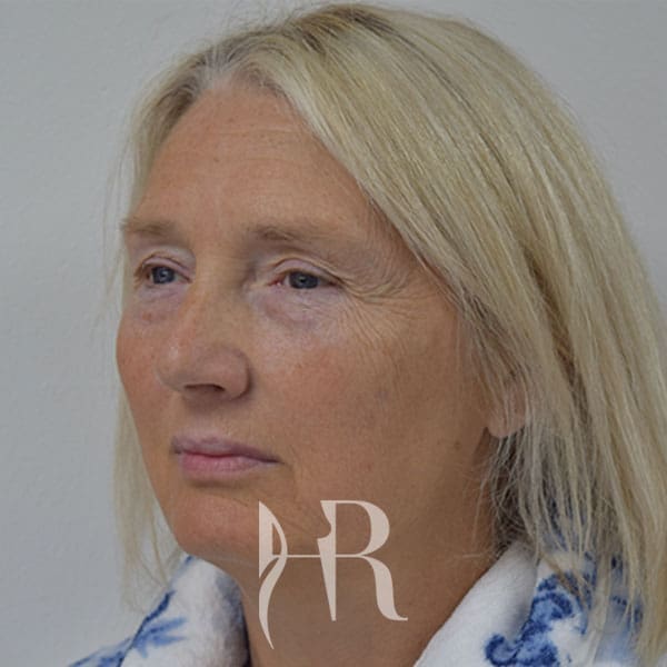 HR Plastic Surgery - Facelift patient before 1