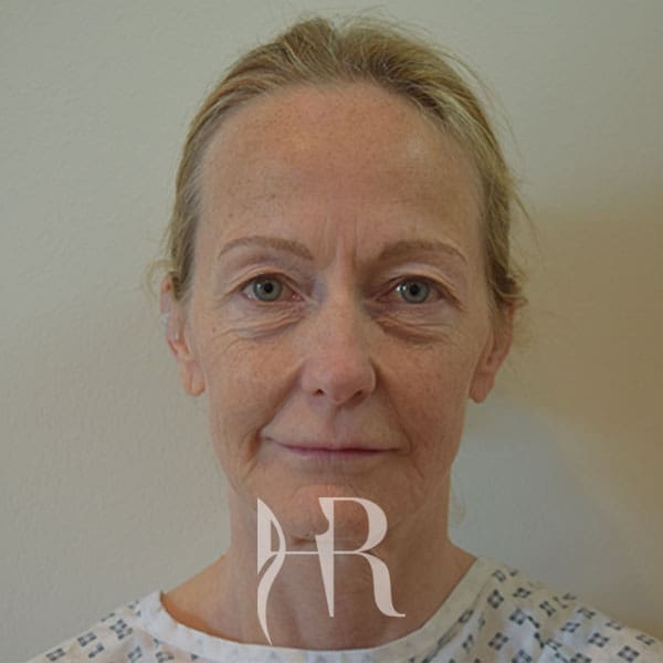 HR Plastic Surgery - Facelift patient before 2
