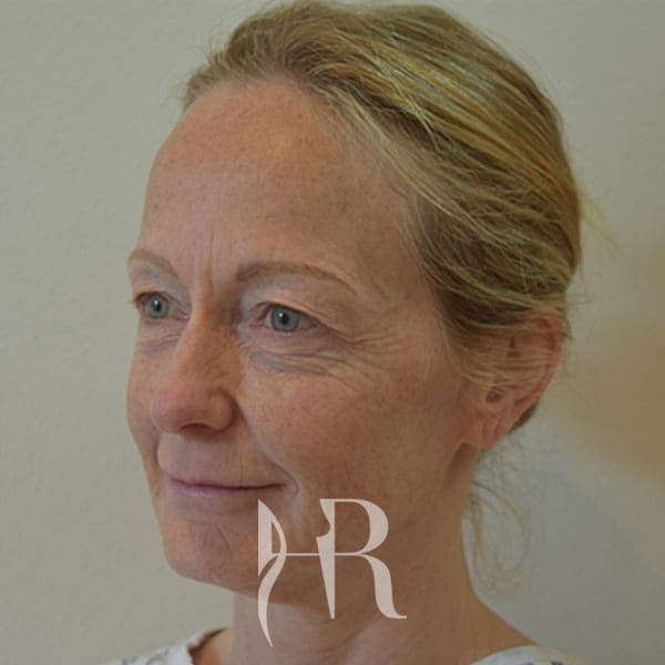 HR Plastic Surgery - Facelift patient before 3