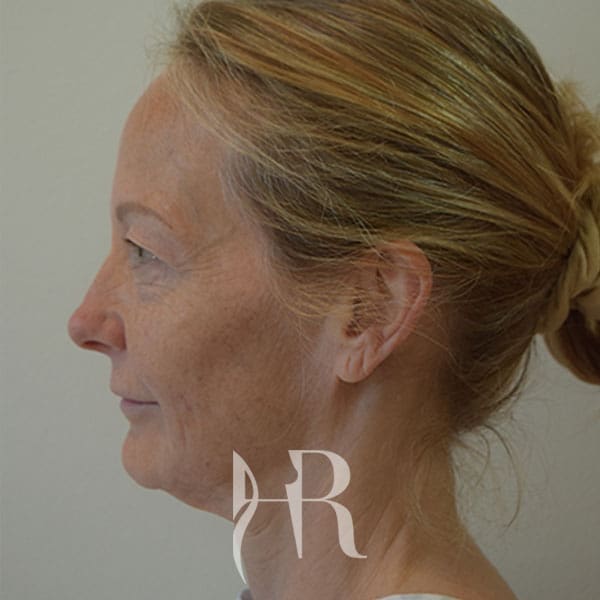 HR Plastic Surgery - Facelift patient before 4