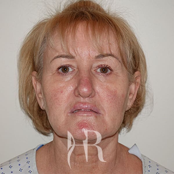 HR Plastic Surgery - Facelift patient before 5