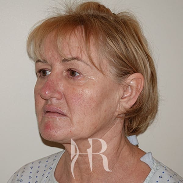 HR Plastic Surgery - Facelift patient before 6