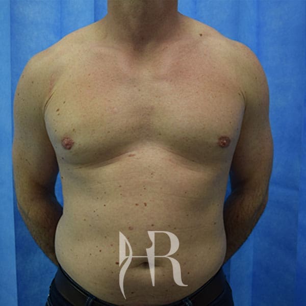 HR Plastic Surgery - Male Breast Reduction patient after 4