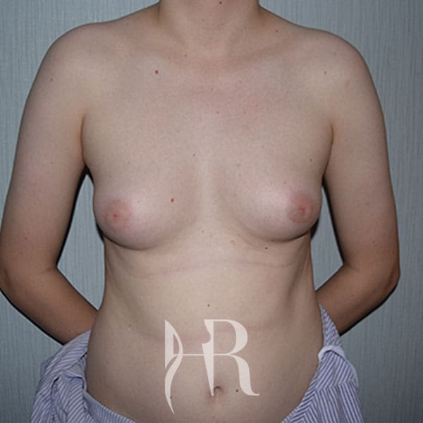 HR Plastic Surgery - Male Breast Reduction patient before 1