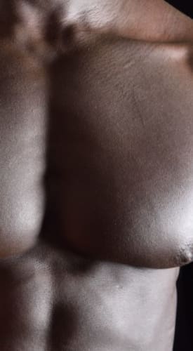 HR Plastic Surgery - Gynaecomastia Good Candidate