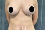 HR Plastic Surgery - Internal Mesh Bra Lift patient after 1