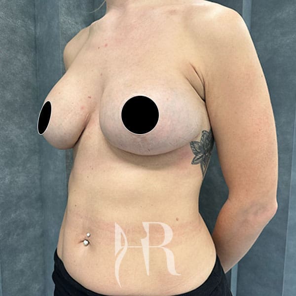 HR Plastic Surgery - Internal Mesh Bra Lift patient after 2