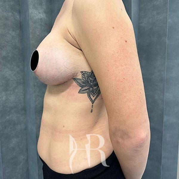 HR Plastic Surgery - Internal Mesh Bra Lift patient after 3
