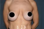 HR Plastic Surgery - Internal Mesh Bra Lift patient before 1