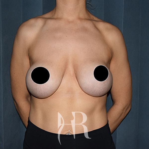 HR Plastic Surgery - Internal Mesh Bra Lift patient before 1