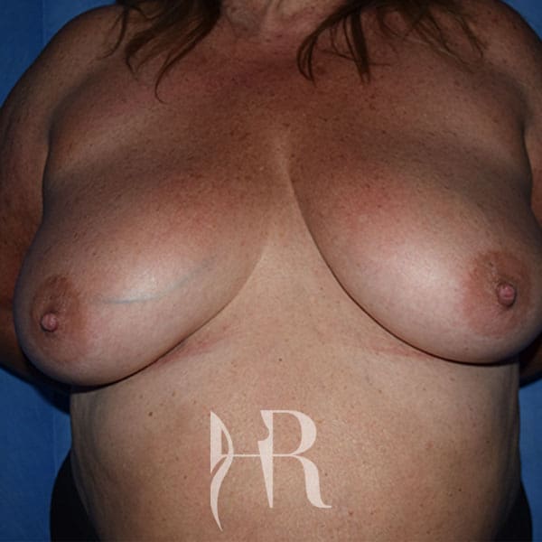 HR Plastic Surgery - Breast & Nipple Variations patient after 1