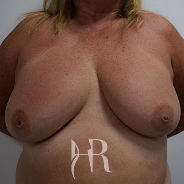 HR Plastic Surgery - Breast & Nipple Variations patient before 1
