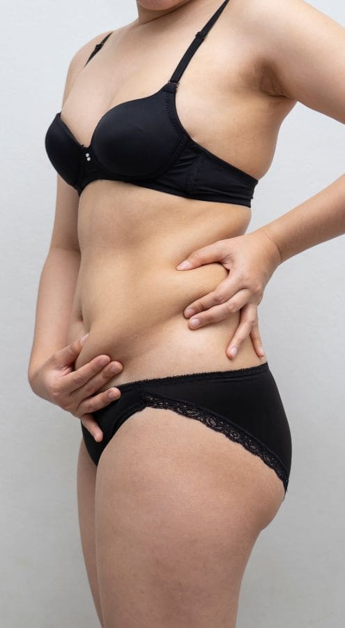 HR Plastic Surgery - Love handles / Excess abdominal fat