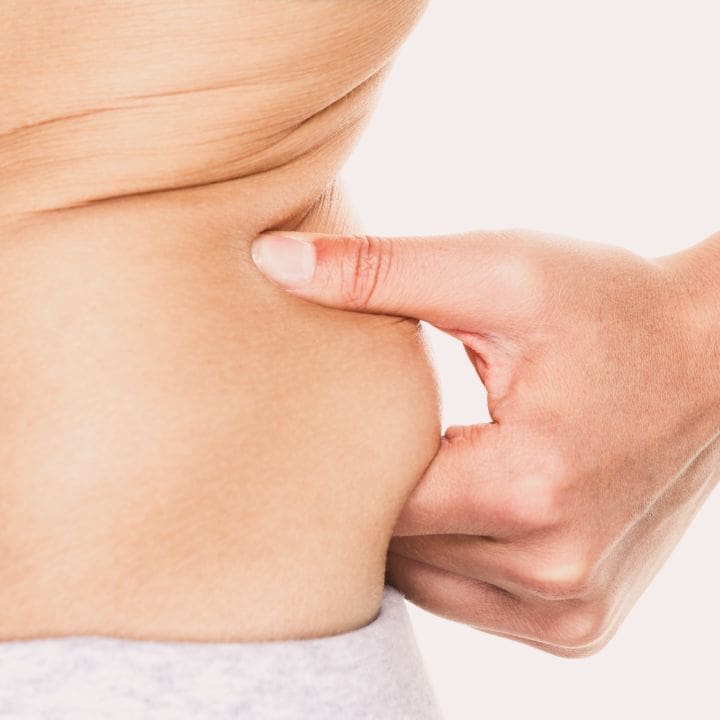 HR Plastic Surgery - Love handles / Excess abdominal fat