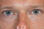 HR Plastic Surgery - Eyelid Surgery (Blepharoplasty) patient after 6