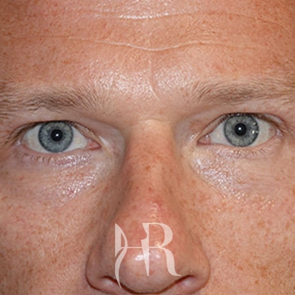 HR Plastic Surgery - Eyelid Surgery (Blepharoplasty) patient after 6