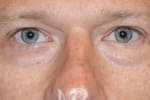 HR Plastic Surgery - Eyelid Surgery (Blepharoplasty) patient before 6