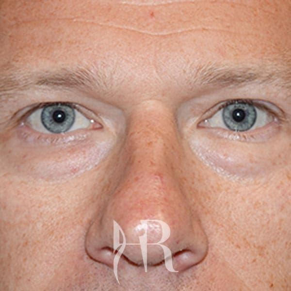 HR Plastic Surgery - Eyelid Surgery (Blepharoplasty) patient before 6
