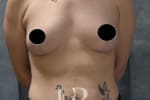 HR Plastic Surgery - Breast Uplift patient after 14