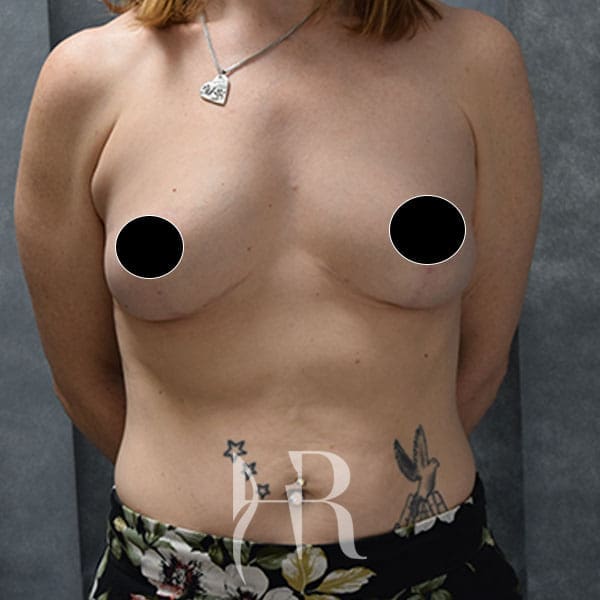 HR Plastic Surgery - Breast Uplift patient after 14