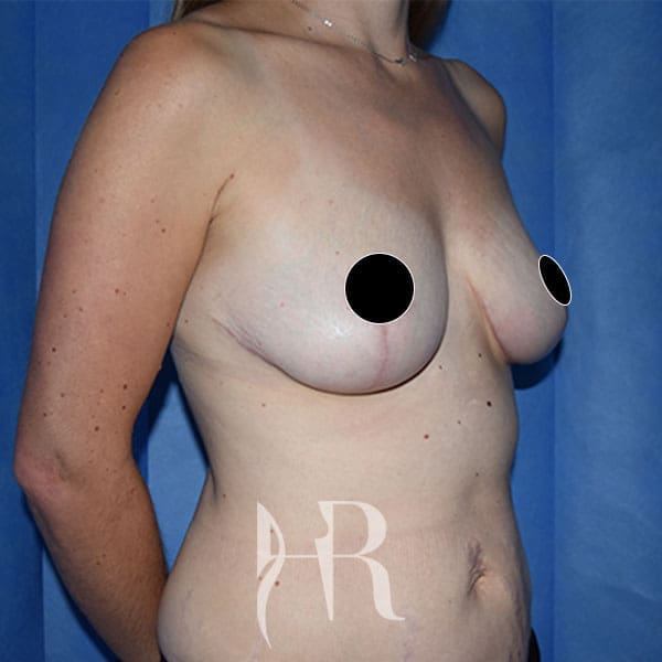 HR Plastic Surgery - Breast Uplift patient after 4