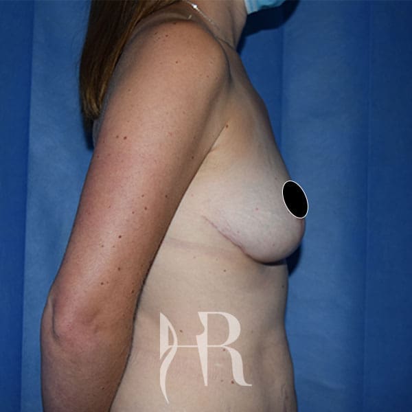 HR Plastic Surgery - Breast Uplift patient after 6