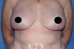 HR Plastic Surgery - Breast Uplift patient after 3