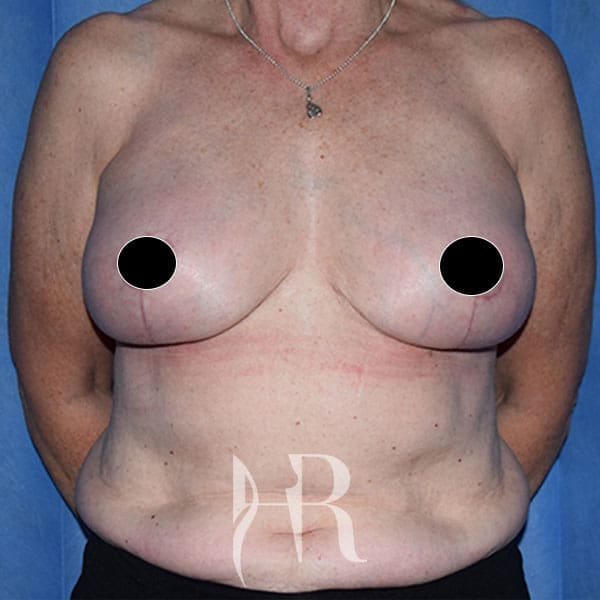 HR Plastic Surgery - Breast Uplift patient after 3