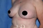 HR Plastic Surgery - Breast Uplift patient after 2