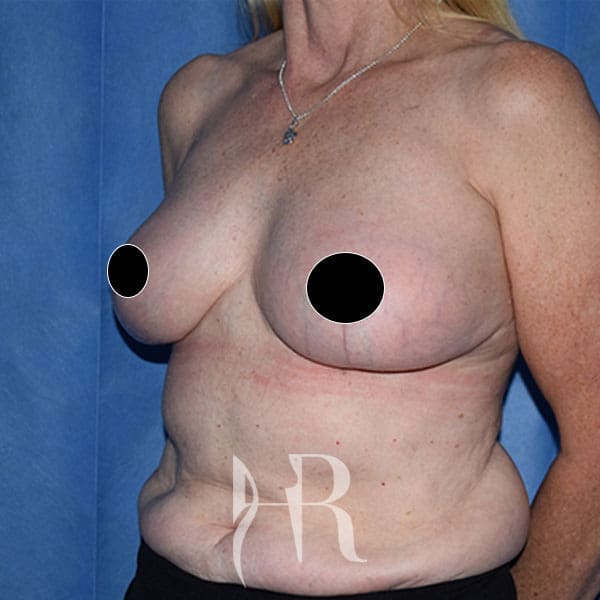 HR Plastic Surgery - Breast Uplift patient after 2