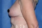 HR Plastic Surgery - Breast Uplift patient after 1