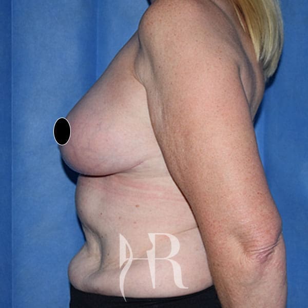 HR Plastic Surgery - Breast Uplift patient after 1