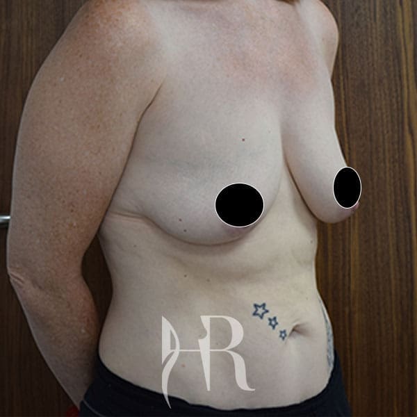 HR Plastic Surgery - Breast Uplift patient before 13