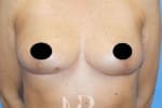 HR Plastic Surgery - Breast Uplift patient after 12