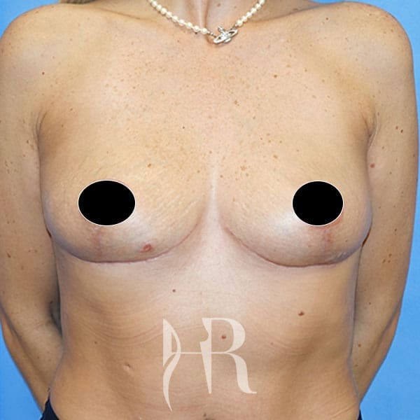 HR Plastic Surgery - Breast Uplift patient after 12