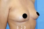 HR Plastic Surgery - Breast Uplift patient after 11