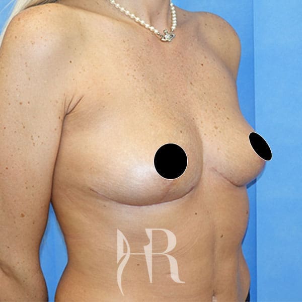 HR Plastic Surgery - Breast Uplift patient after 11