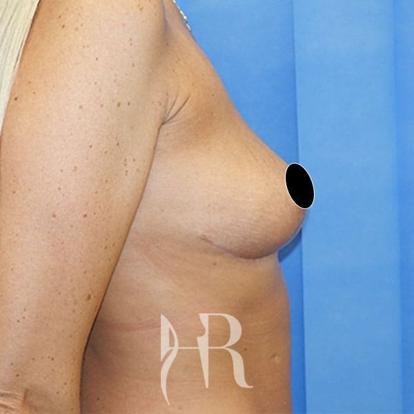 HR Plastic Surgery - Breast Uplift patient after 10