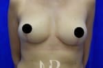 HR Plastic Surgery - Breast Uplift patient after 9